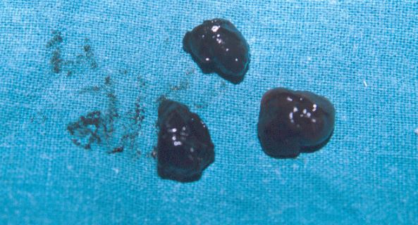 Black specks in vaginal discharge can mean cervical cancer