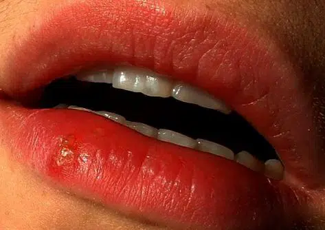 Herpes cold sore spot on lower lip