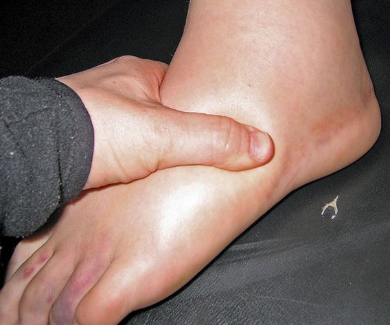 Idiopathic edema may cause generalized edema