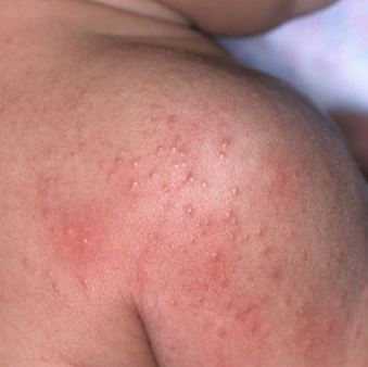 Sweat rash on back of babies