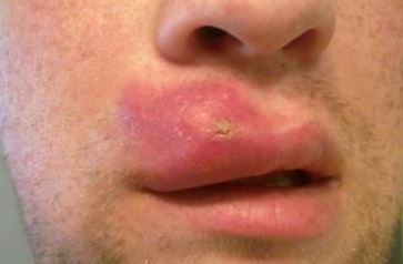 Swollen upper lip due to whiteheads