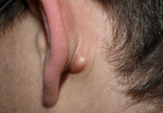 cyst behind ear