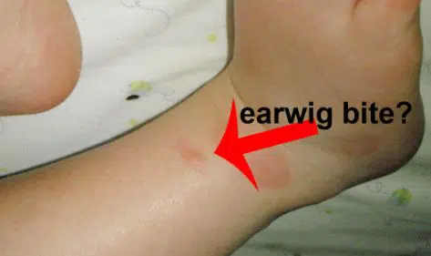 Earwig bite picture