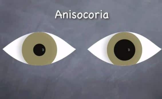 One pupil bigger than the other anisocoria