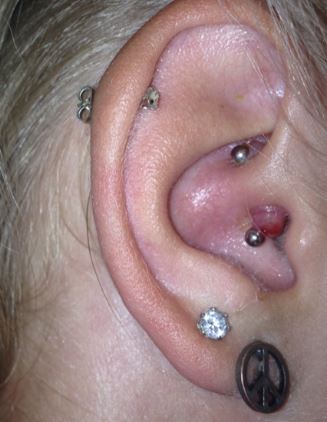 Infected daith piercing bump or keloid