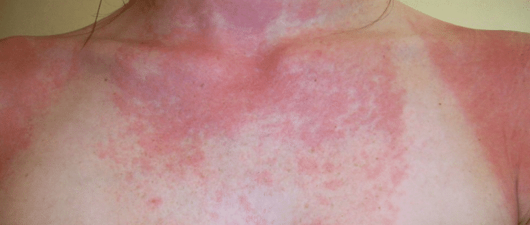 Sun Allergy Rash Types Hives Causes Symptoms Pictures Prevention 