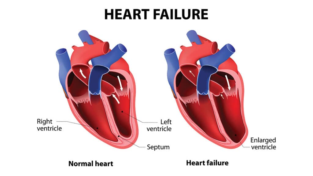 Systolic Heart Failure Symptoms Causes Diagnosis Treatment