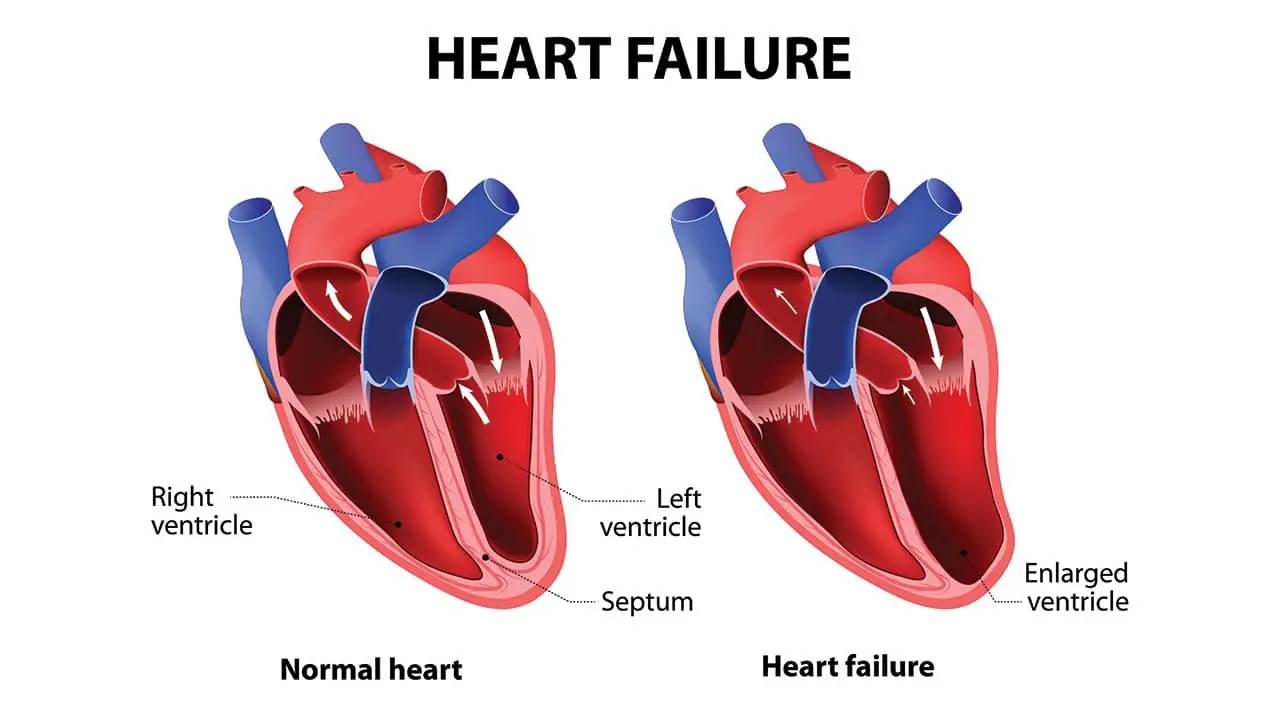 Systolic Heart Failure Symptoms Causes Diagnosis Treatment 