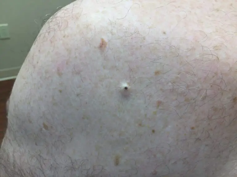 Dilated Pore of Winer Picture, Causes, Treatment and Prevention Treat, Cure Fast