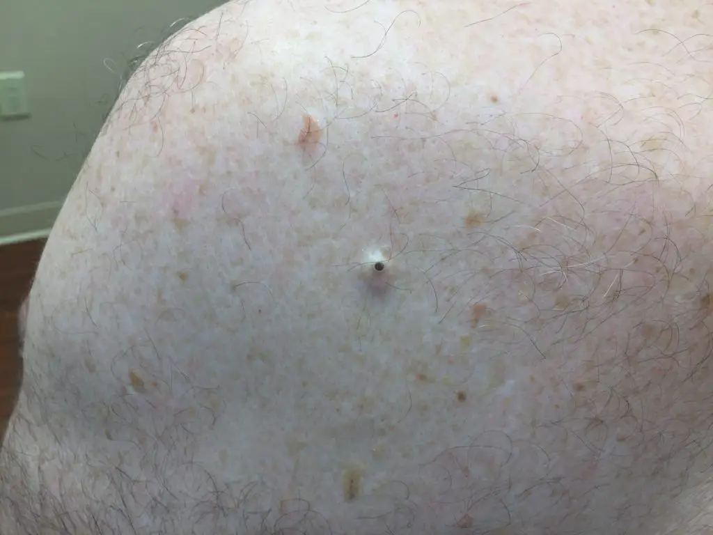 Dilated Pore Of Winer Picture Causes Treatment And Prevention Treat Cure Fast 