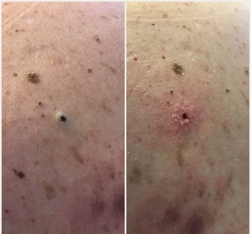 Dilated Pore Of Winer Picture Causes Treatment And Prevention Treat Cure Fast 