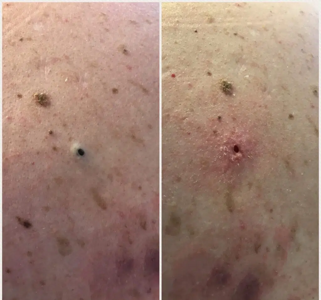 dilated pore of winer