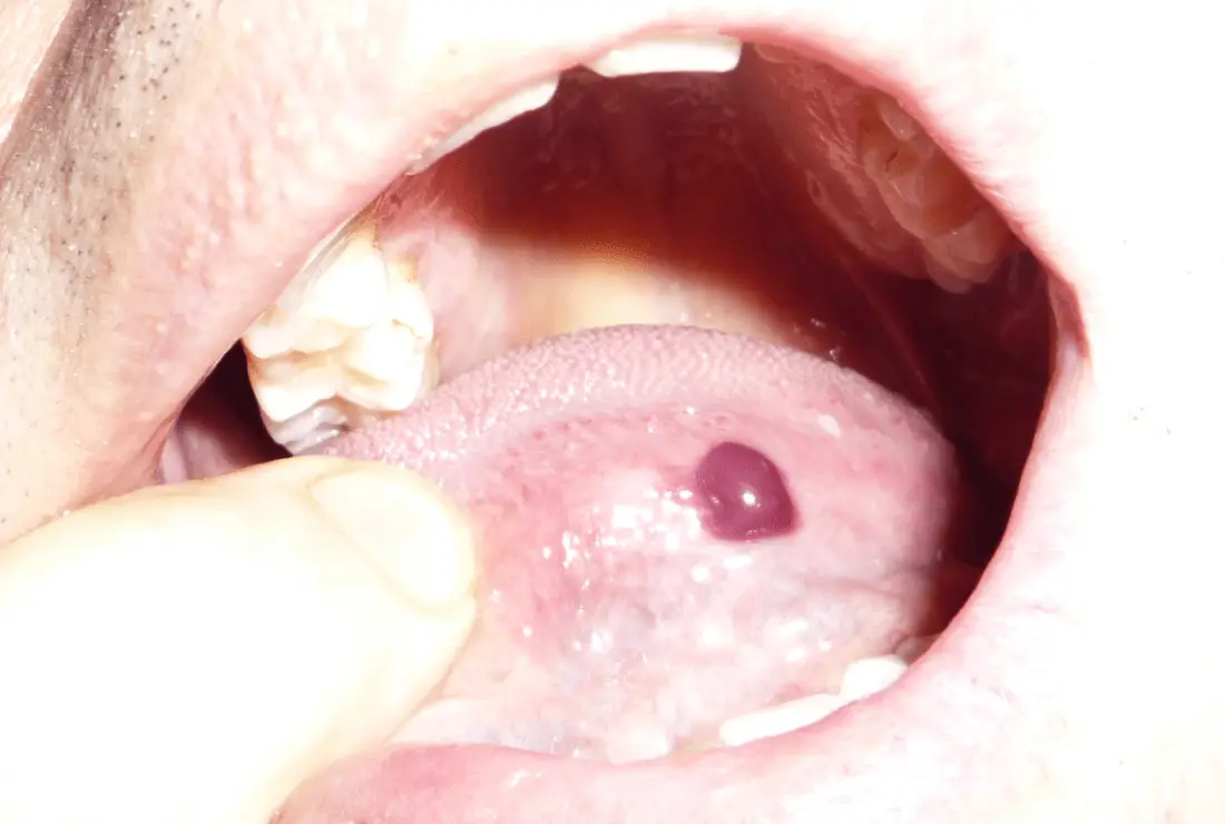 15-oral-soft-tissue-lesions-and-minor-oral-surgery-pocket-dentistry