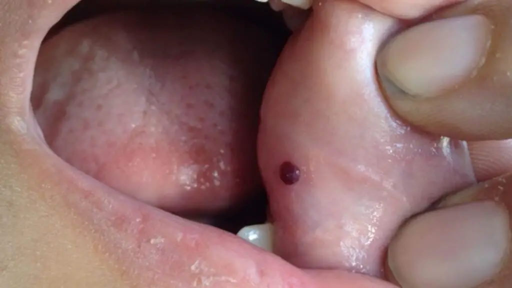 blood blisters in mouth