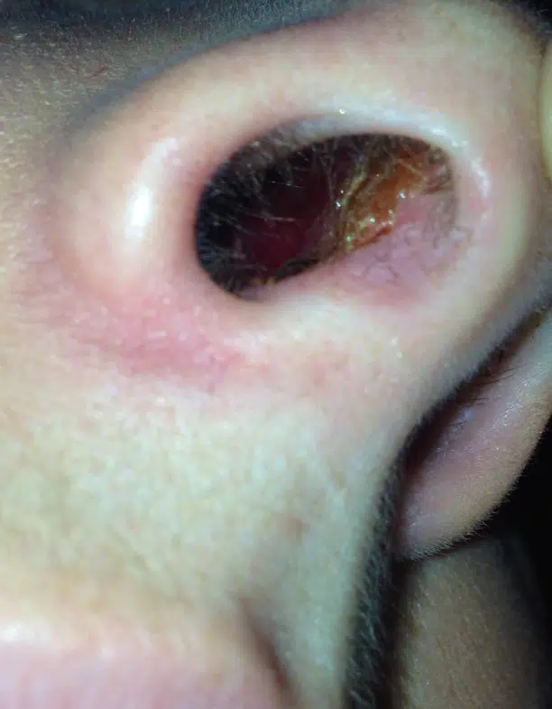 Scabs In The Nose