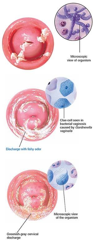 What Is Bacterial Vaginosis Symptoms Causes And Treatment Treat 